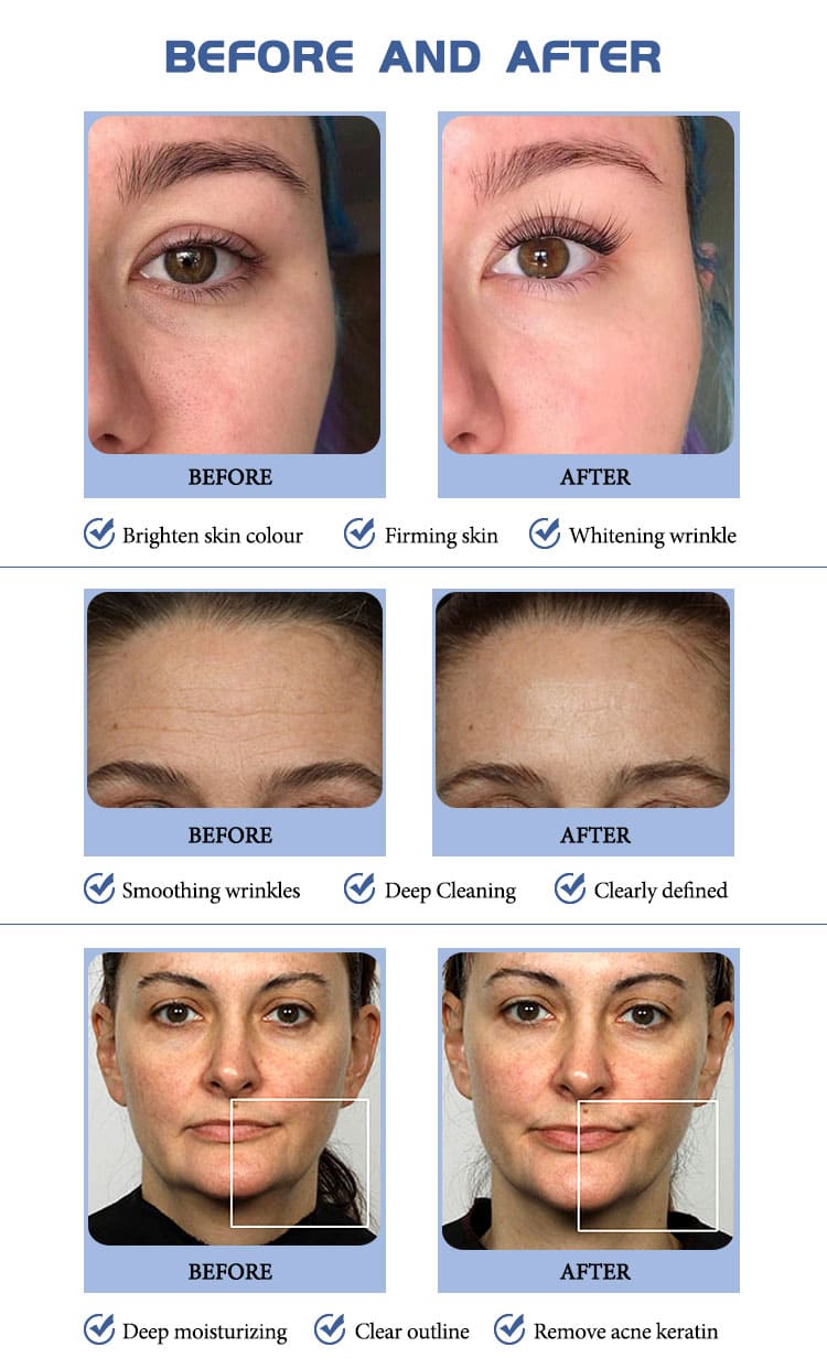 hydrafacial equipment before after