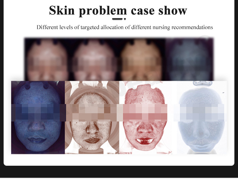 skin analysis machine cost